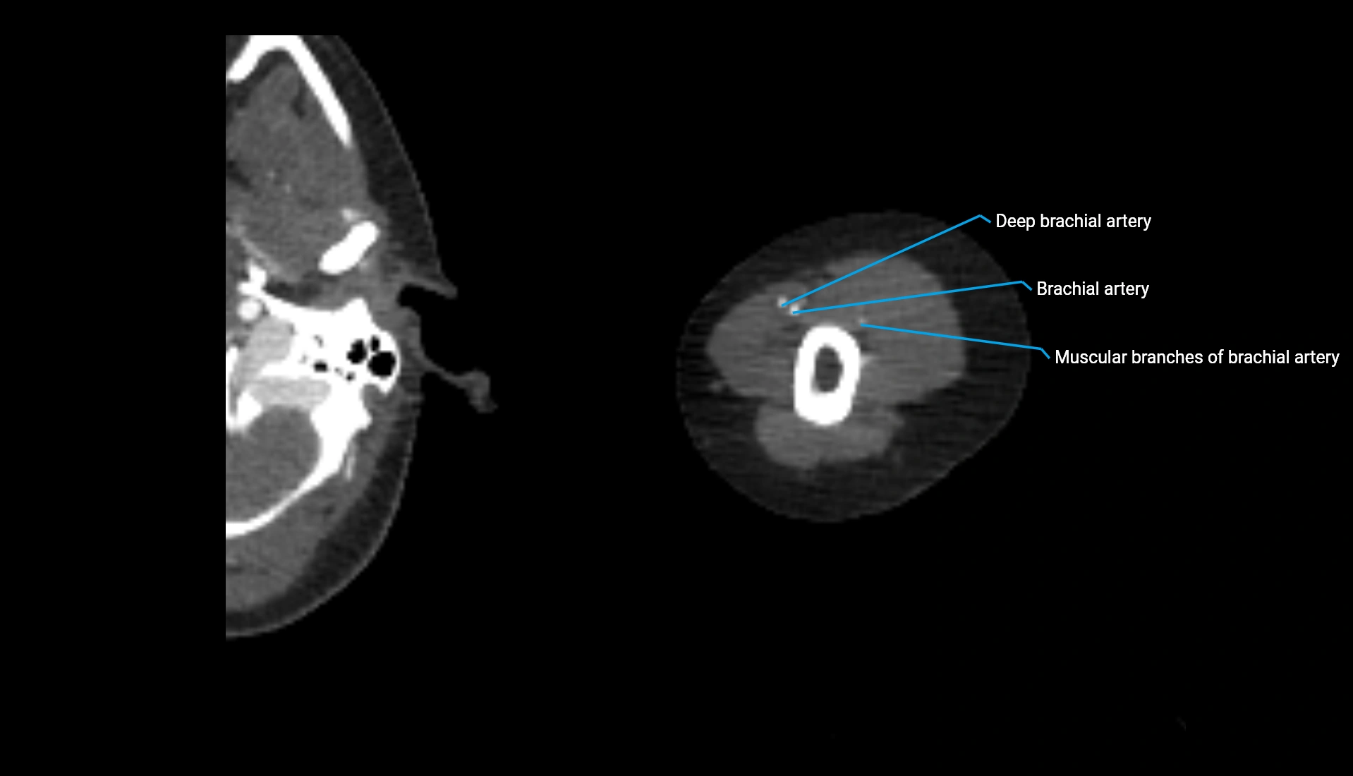 CTA upper limb axial cross sectional anatomy labelled image 268 (2).webp